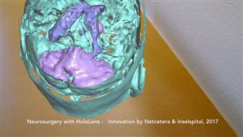 Hololens im Einsatz für die Neurochirurgie